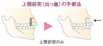 出っ歯 受け口 反対咬合 診療案内 共立美容外科宇都宮院 栃木県宇都宮市の美容外科 美容皮膚科 美容整形