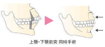 出っ歯 受け口 反対咬合 診療案内 共立美容外科宇都宮院 栃木県宇都宮市の美容外科 美容皮膚科 美容整形